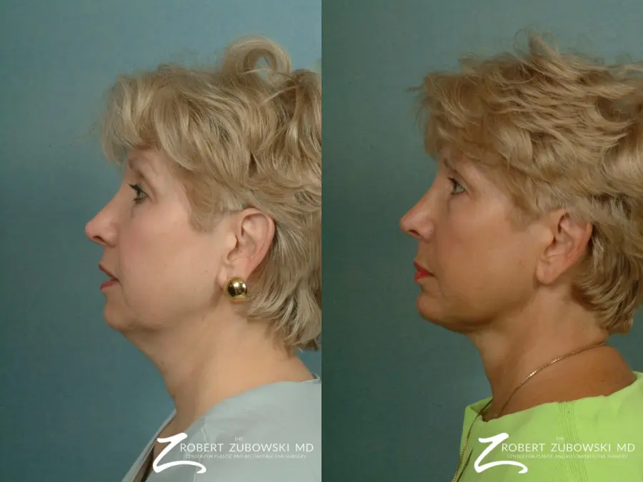 Neck Lift: Patient 2 - Before and After 2