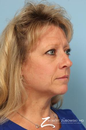 Blepharoplasty: Patient 28 - Before and After Image 2
