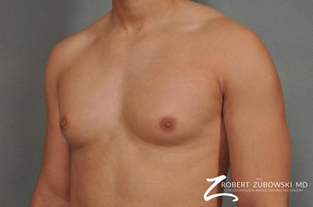 Gynecomastia: Patient 3 - Before and After Image 2