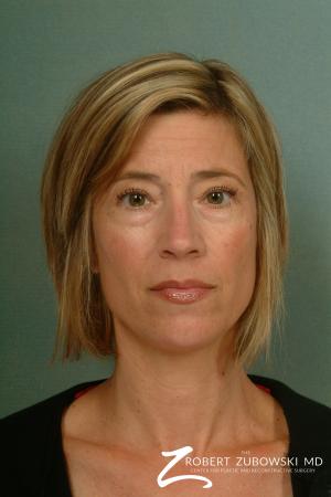 Chemical Peel: Patient 2 - Before Image 1