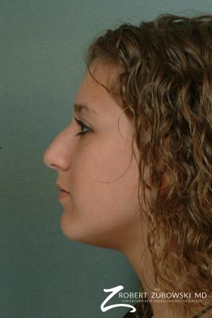 Rhinoplasty: Patient 12 - Before and After Image 2