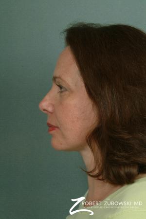 Facelift: Patient 11 - After Image 2