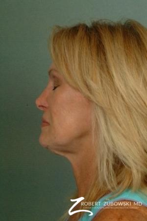 Facelift: Patient 12 - Before and After Image 2