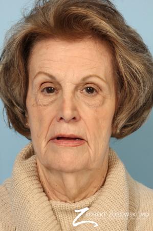 Blepharoplasty: Patient 36 - Before Image 1