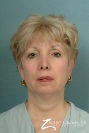 Liposuction: Patient 3 - Before Image 1