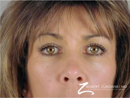 Blepharoplasty: Patient 2 - After Image 1