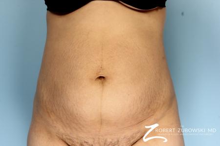 Liposuction: Patient 44 - Before Image 1