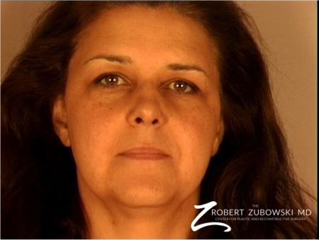 Brow Lift: Patient 3 - Before Image 1