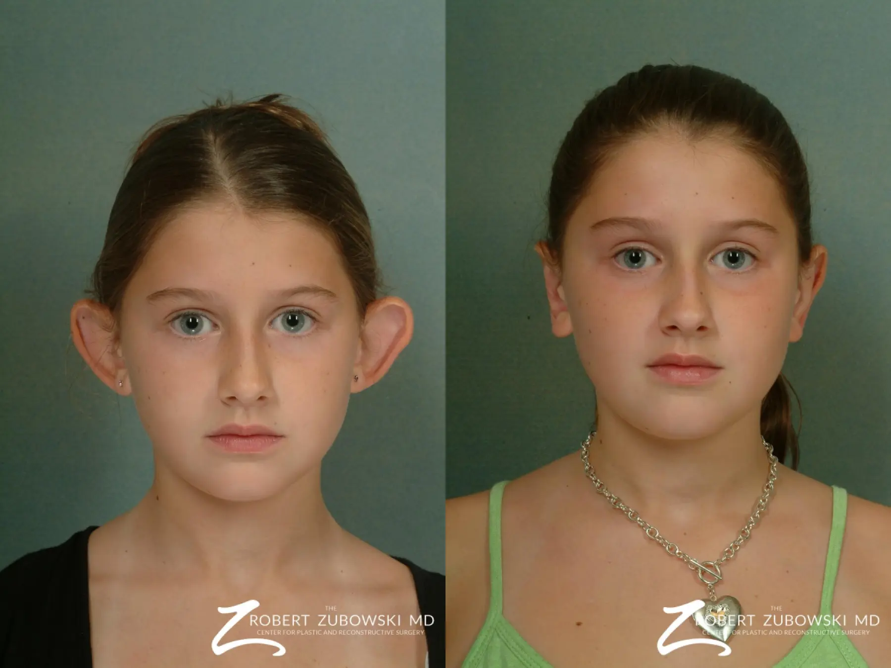 Otoplasty: Patient 4 - Before and After 1