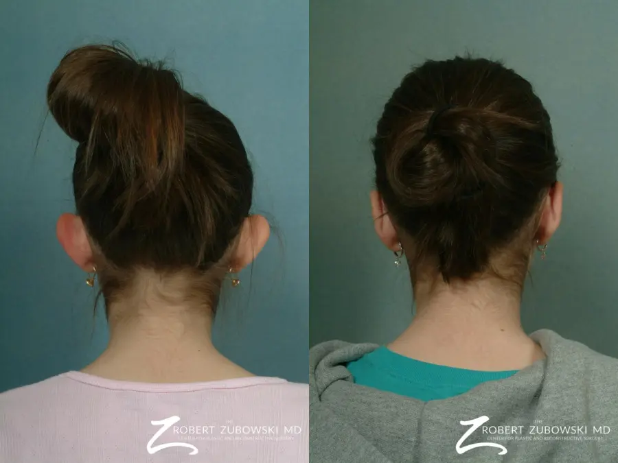 Otoplasty: Patient 3 - Before and After 2