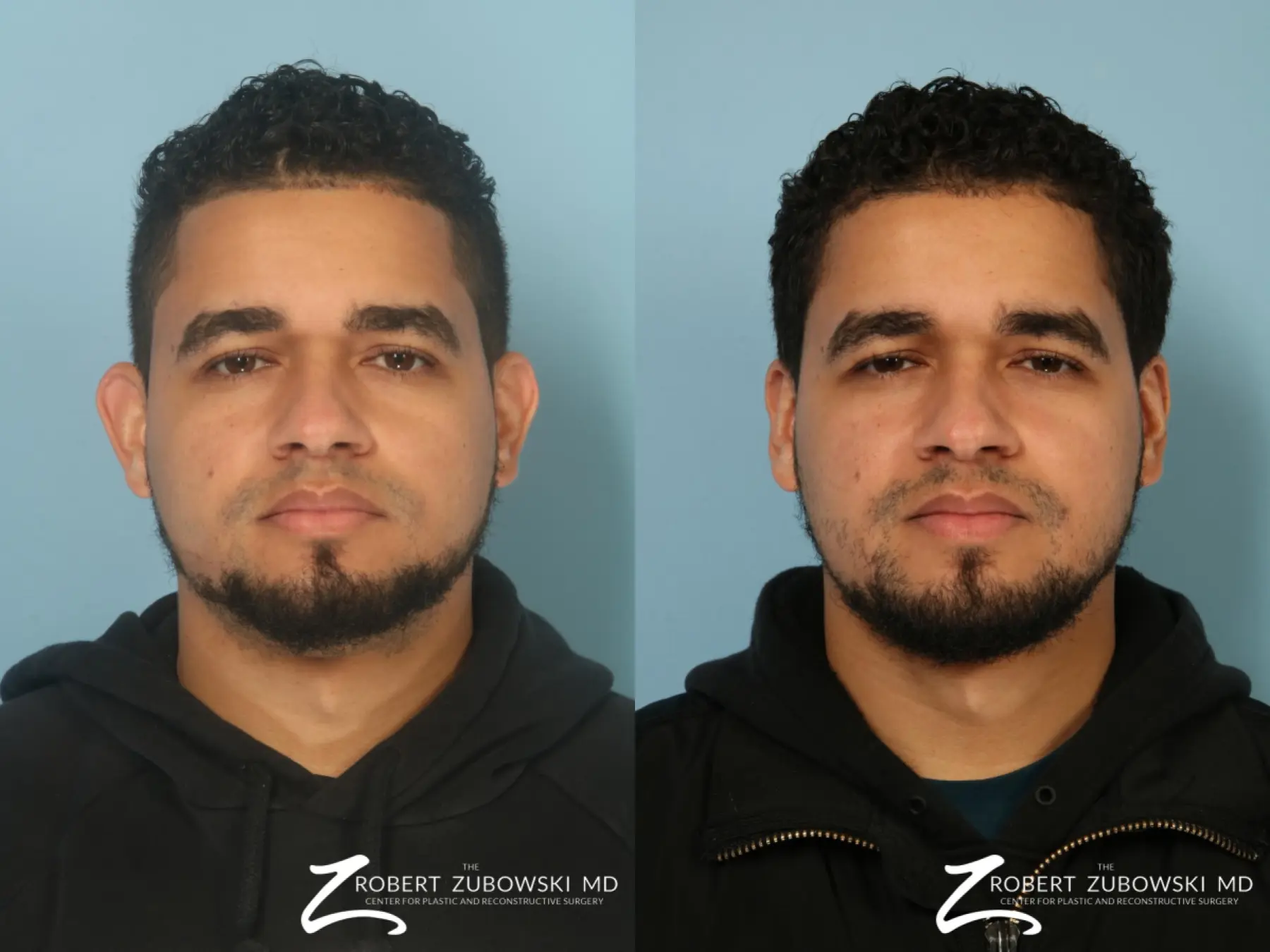 Otoplasty-for-men: Patient 1 - Before and After  