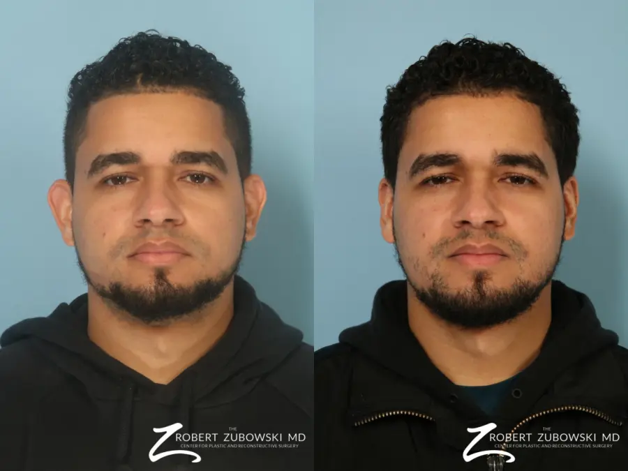 Otoplasty-for-men: Patient 1 - Before and After  