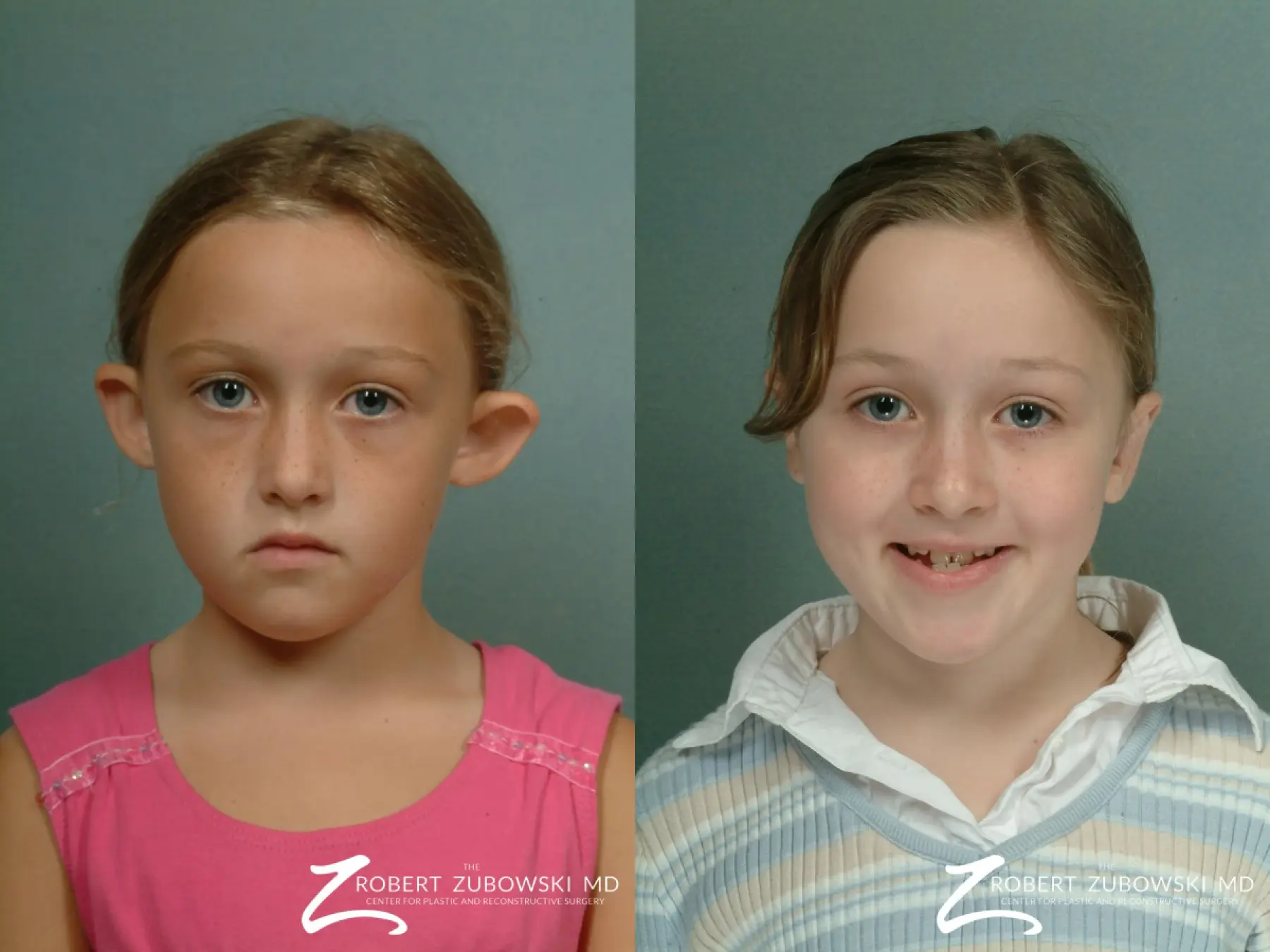 Otoplasty: Patient 1 - Before and After  