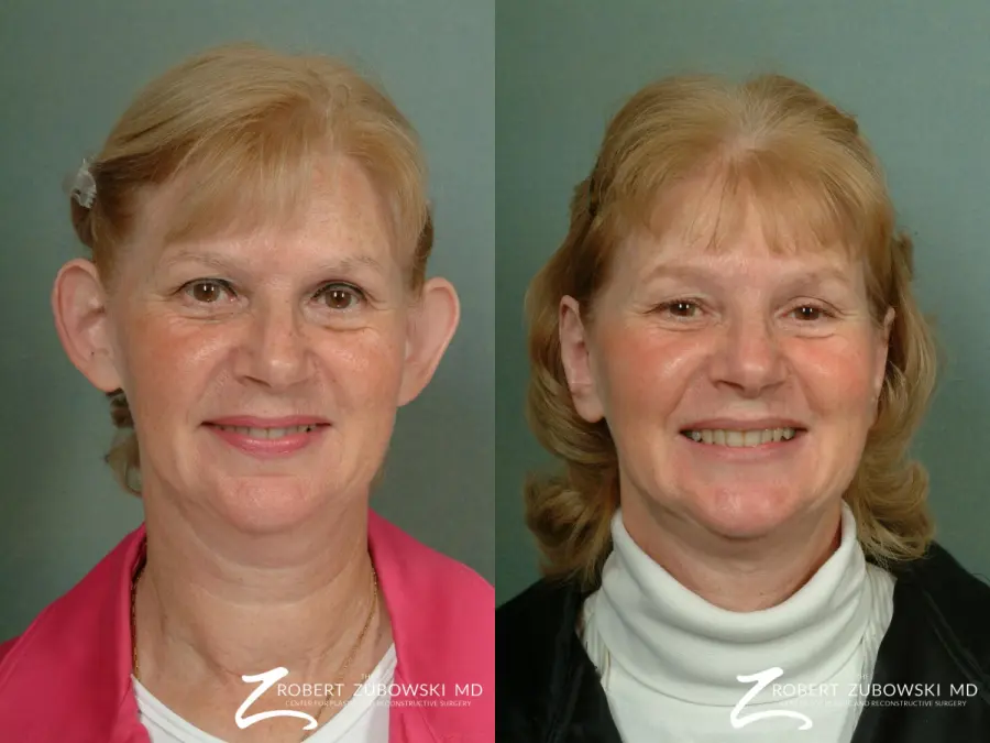 Otoplasty: Patient 2 - Before and After 1