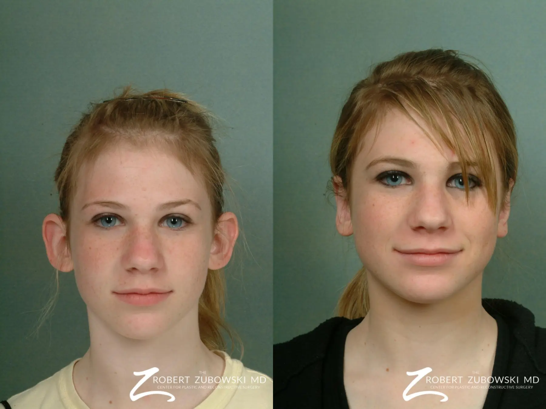 Otoplasty: Patient 5 - Before and After  