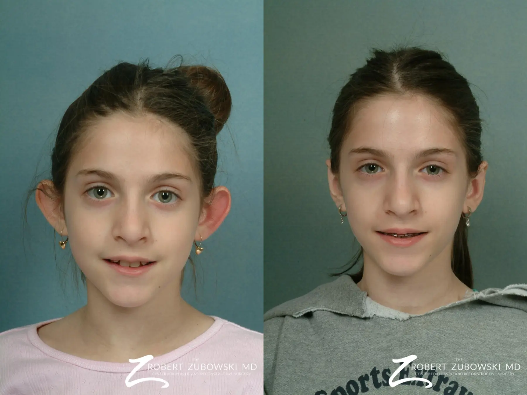Otoplasty: Patient 3 - Before and After 1
