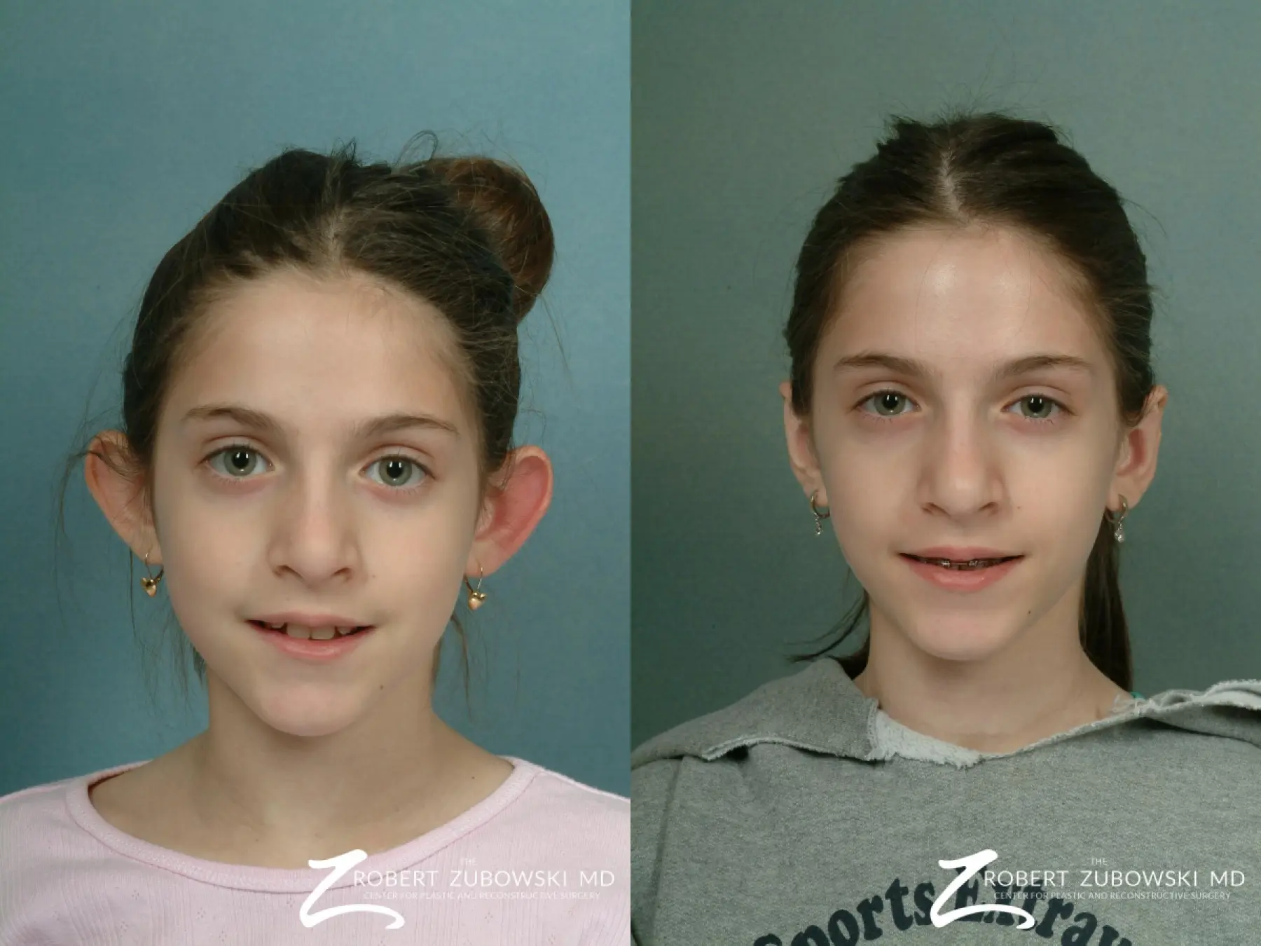 Otoplasty: Patient 3 - Before and After  