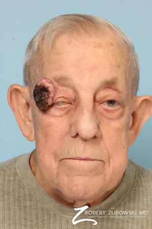 Mohs Closure: Patient 7 - Before Image 1