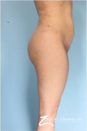 Butt Augmentation: Patient 1 - After Image 1