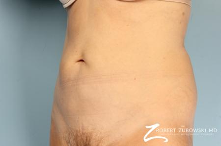 CoolSculpting®: Patient 4 - After Image 3