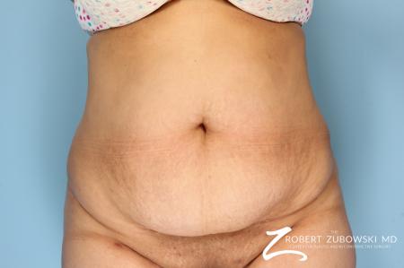 Tummy Tuck: Patient 15 - Before Image 1