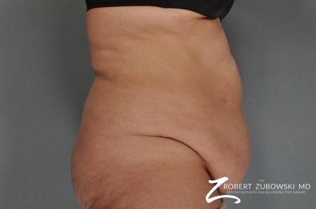 Tummy Tuck: Patient 7 - Before and After Image 2