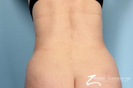 Liposuction: Patient 14 - After Image 1