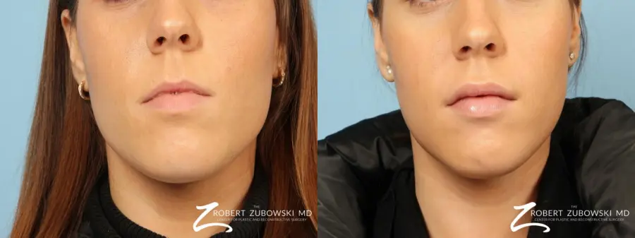 Permanent Lip Enhancement: Patient 2 - Before and After 1