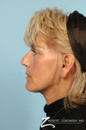 Facelift: Patient 27 - After Image 2