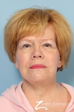 Facelift: Patient 26 - After Image 1