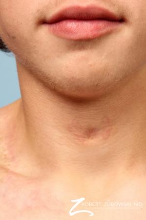 Scar Revision: Patient 3 - Before Image 1