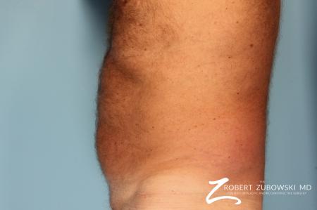 Liposuction: Patient 18 - Before Image 2