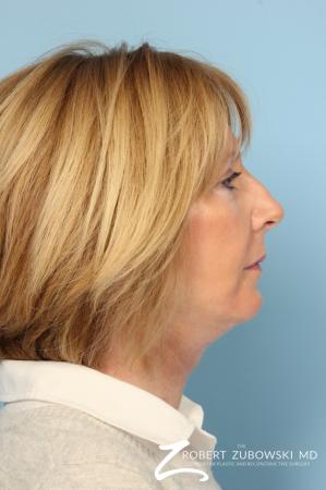 Facelift: Patient 20 - After Image 2