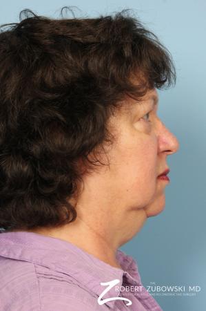 Facelift: Patient 19 - Before and After Image 2