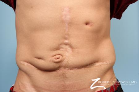 Scar Revision: Patient 2 - Before Image 1