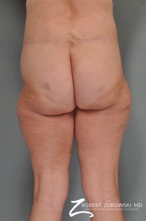 Body Lift: Patient 1 - After Image 2