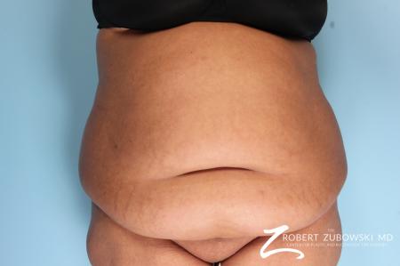 Tummy Tuck: Patient 19 - Before Image 1