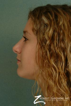Rhinoplasty: Patient 12 - After Image 2