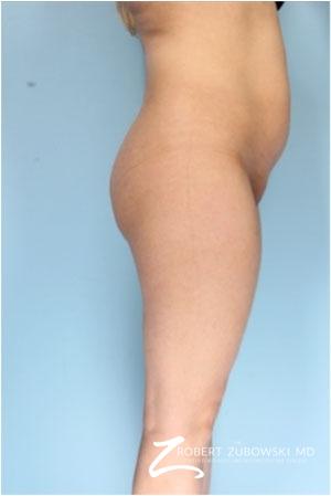 Butt Augmentation: Patient 1 - Before Image 1