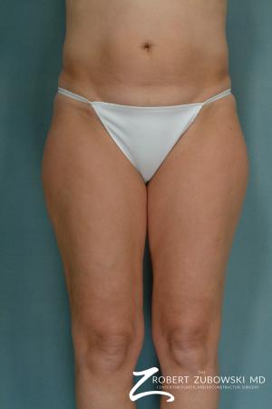 Liposuction: Patient 33 - Before Image 2
