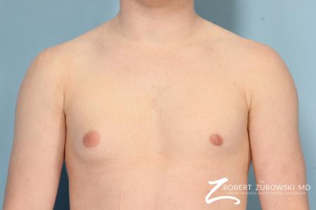 Gynecomastia: Patient 11 - Before Image 1