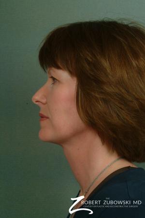 Facelift: Patient 5 - After Image 2