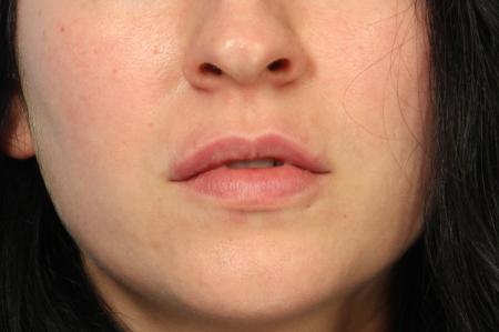 Fillers: Patient 1 - After Image 1