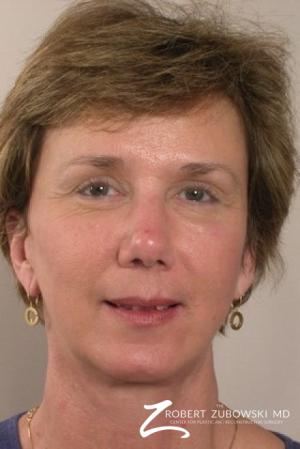 Facelift: Patient 8 - After Image 1