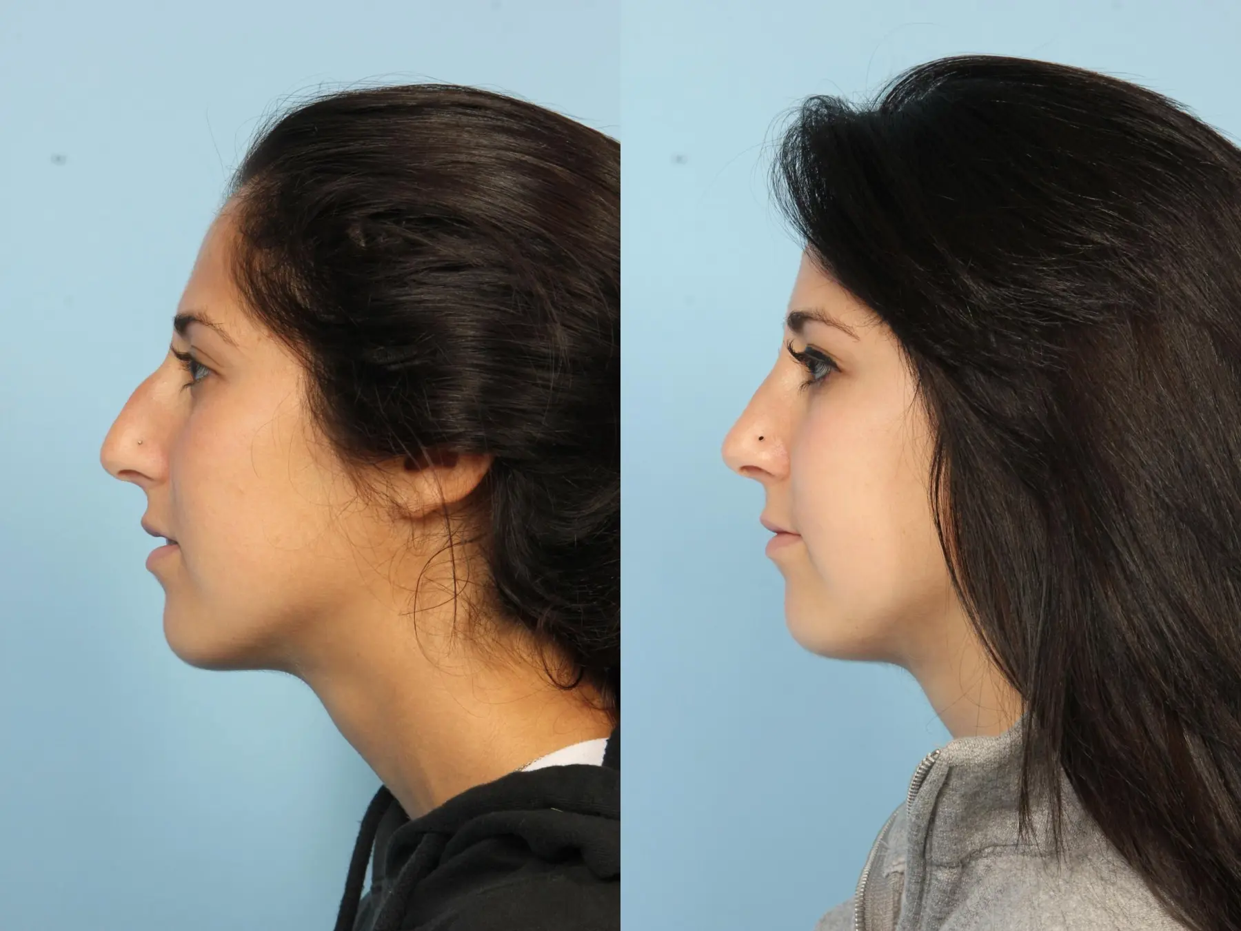 Rhinoplasty: Patient 11 - Before and After 2