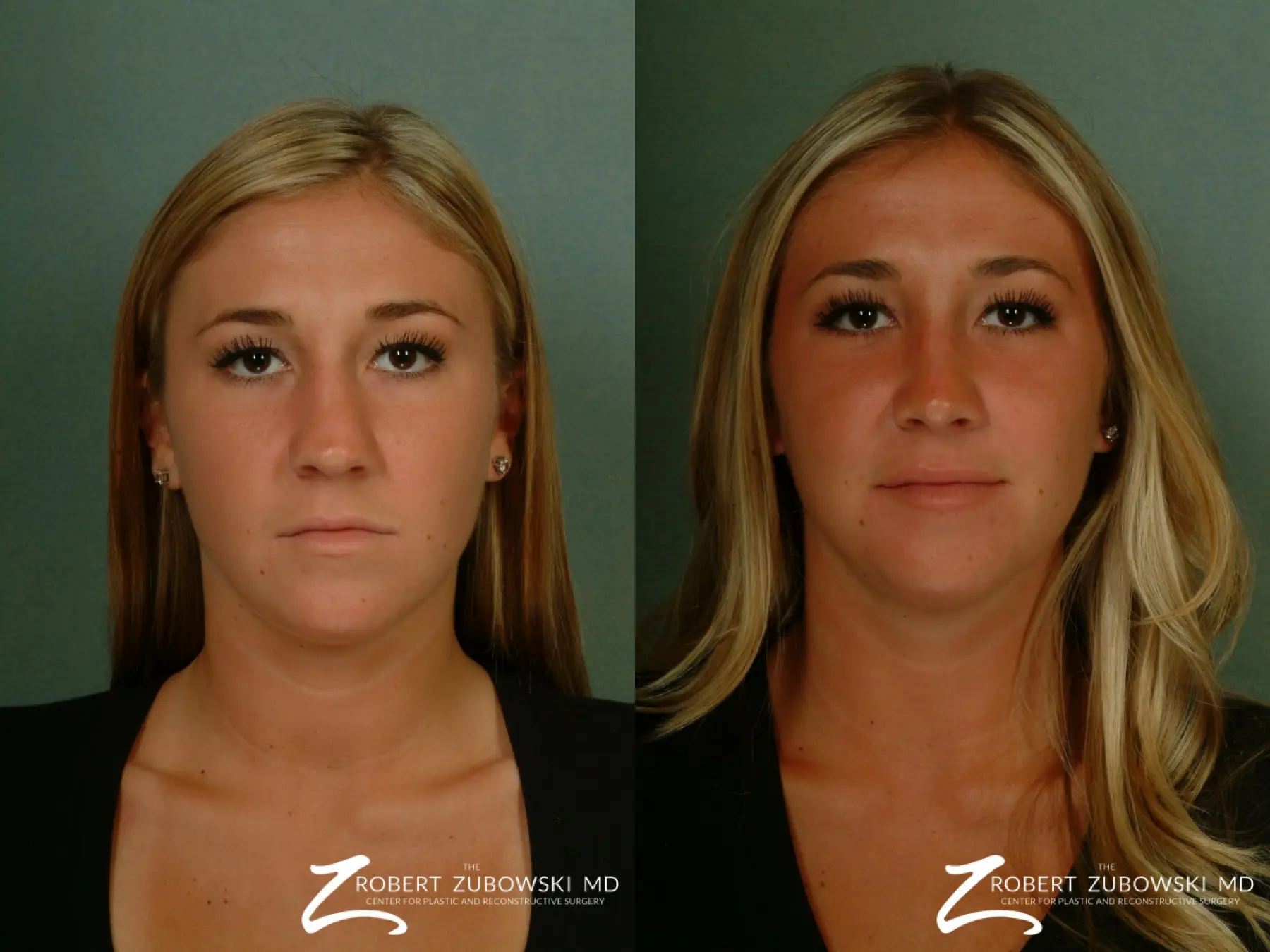 Rhinoplasty: Patient 2 - Before and After  