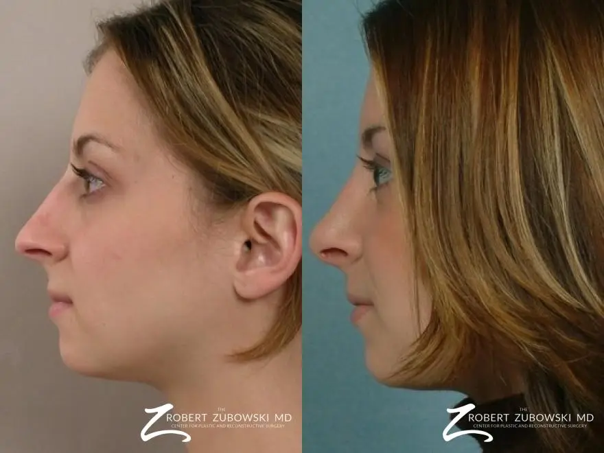 Rhinoplasty: Patient 21 - Before and After 2