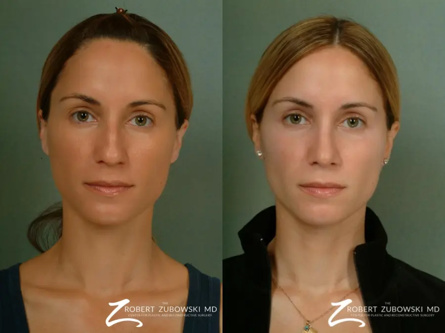 Rhinoplasty: Patient 4 - Before and After 1