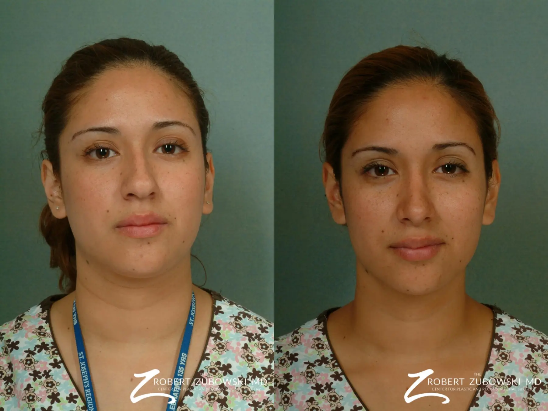Rhinoplasty: Patient 20 - Before and After 1