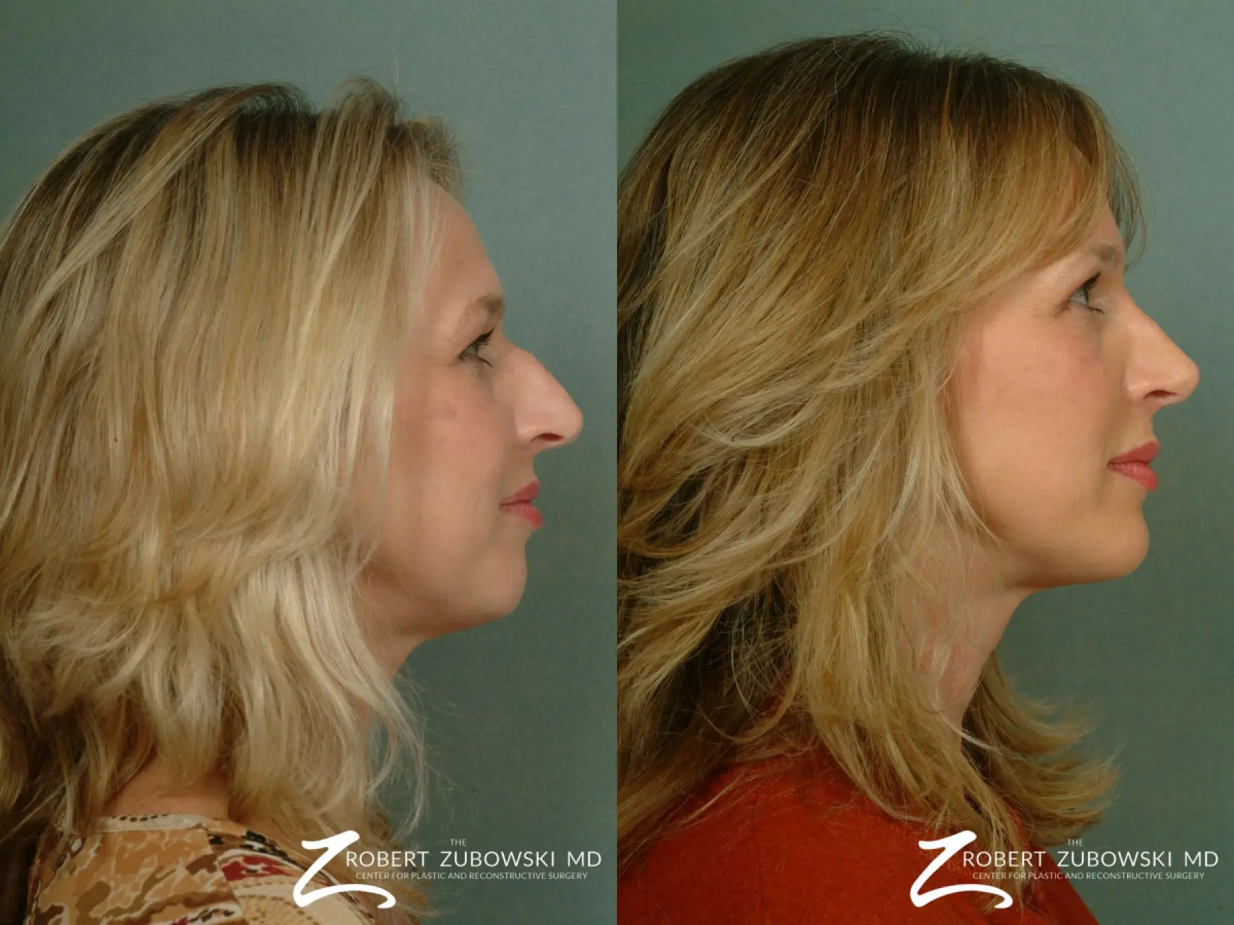Rhinoplasty: Patient 22 - Before and After 3